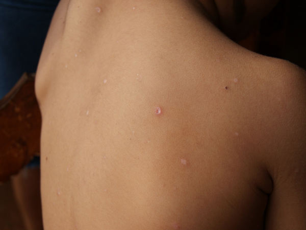 Corpo fica marcado por cicatrizes; no geral, sintomas desaparecem em uma semana. Foto: Hedio Fazan 