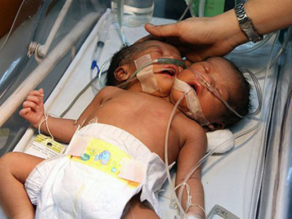 No ano passado um bebê Siamês nasceu nas Filipinas. Foto: Revista Época