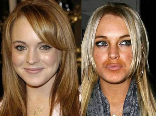 Esse preenchimento labial não favoreceu mesmo Lindsay Lohan Foto: Montagem
