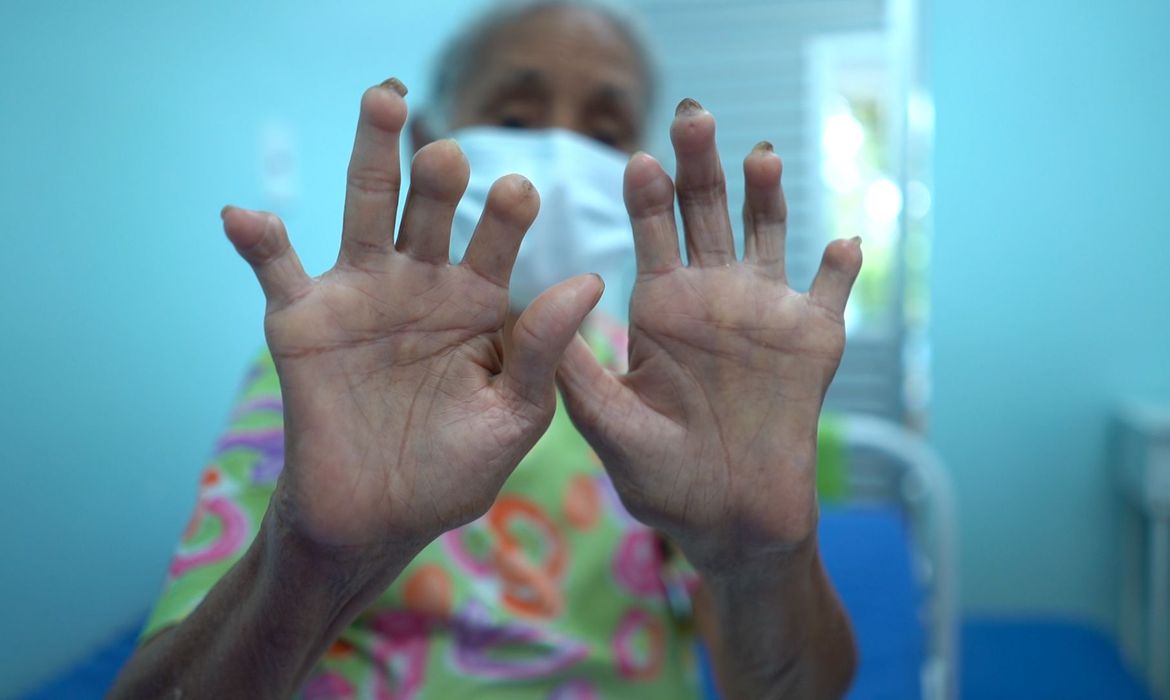 Purple January Campaign fights prejudice regarding leprosy – Dorados Agora