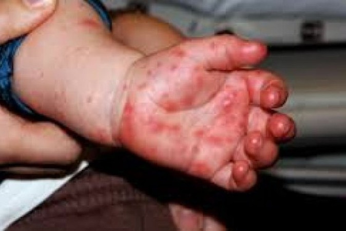 Síndrome mão-pé-boca   é uma doença altamente contagiosafoto - divulgação caso ocorrido no Paraná