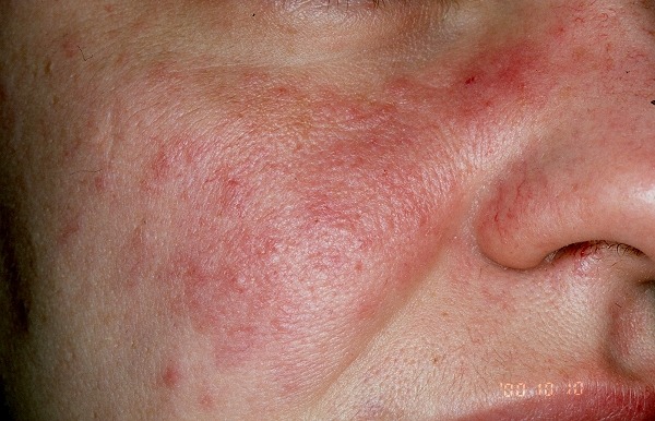 Manchas na pele principalmente em áreas de exposição solar ocorrem nos pacientes com lúpus 